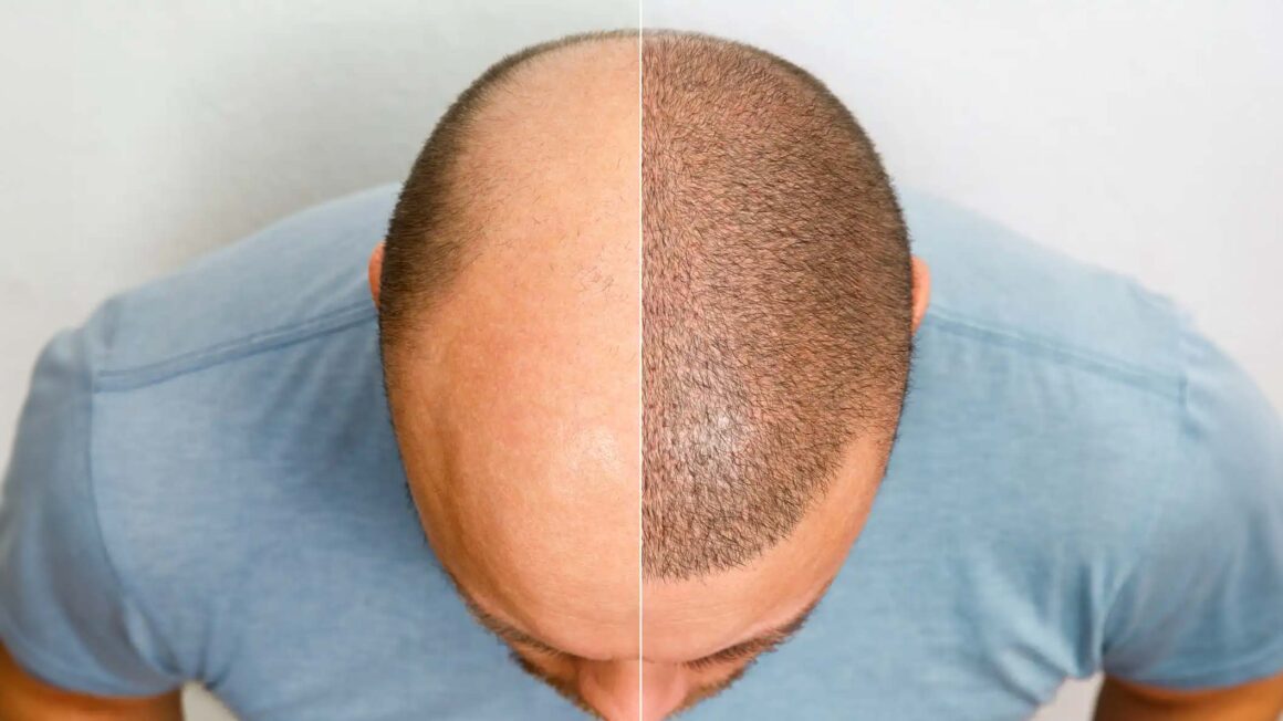 Hair Transplantation