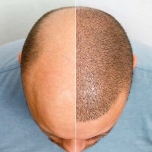 Hair Transplantation