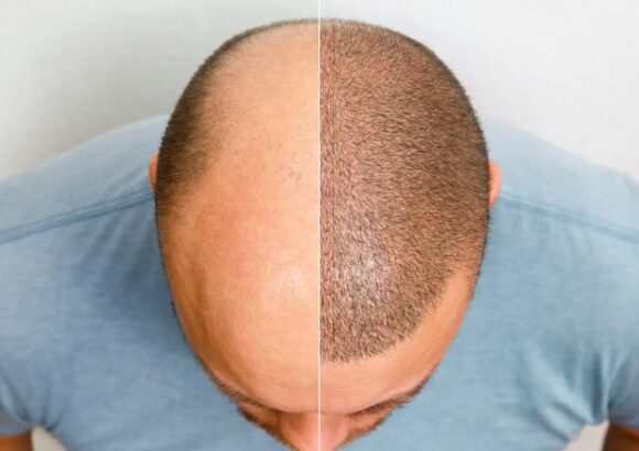 Hair Transplantation