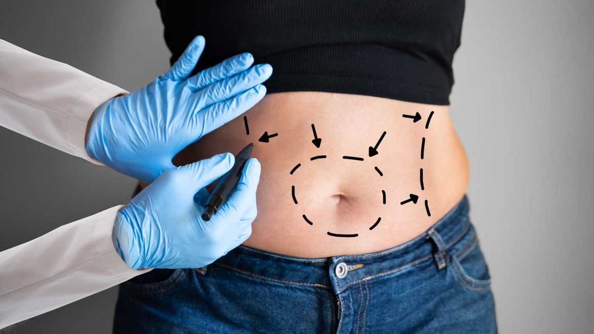 Abdominoplasty (Tummy Tuck)