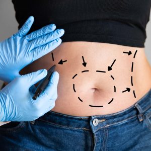 Abdominoplasty (Tummy Tuck)