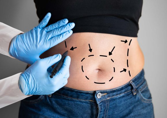 Abdominoplasty (Tummy Tuck)