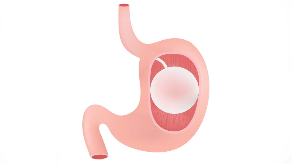 gastric balloon