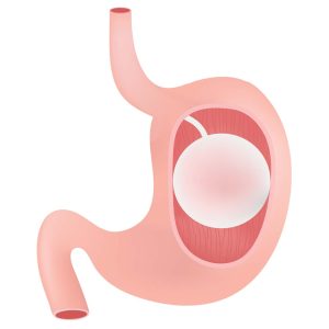 gastric balloon