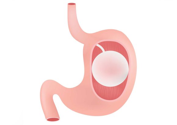 gastric balloon