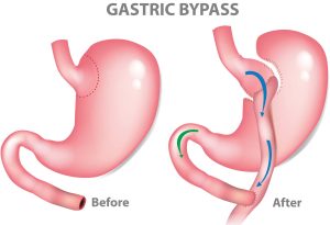 gastric bypass