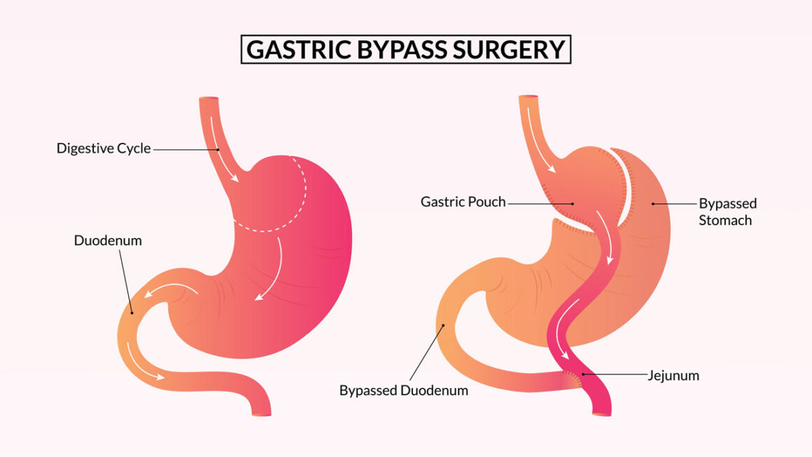 Gastric Bypass