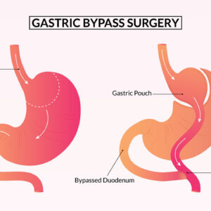 Gastric Bypass