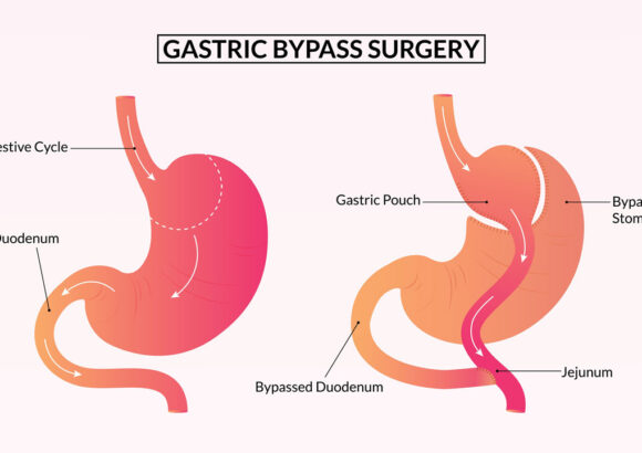 Gastric Bypass