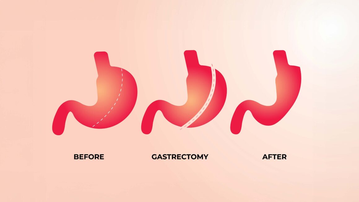 Sleeve Gastrectomy