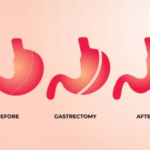 Sleeve Gastrectomy