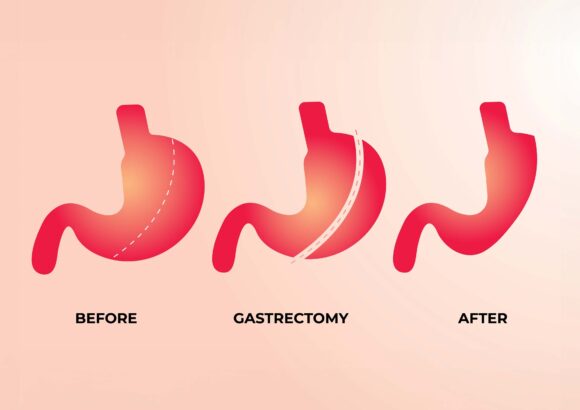 Sleeve Gastrectomy